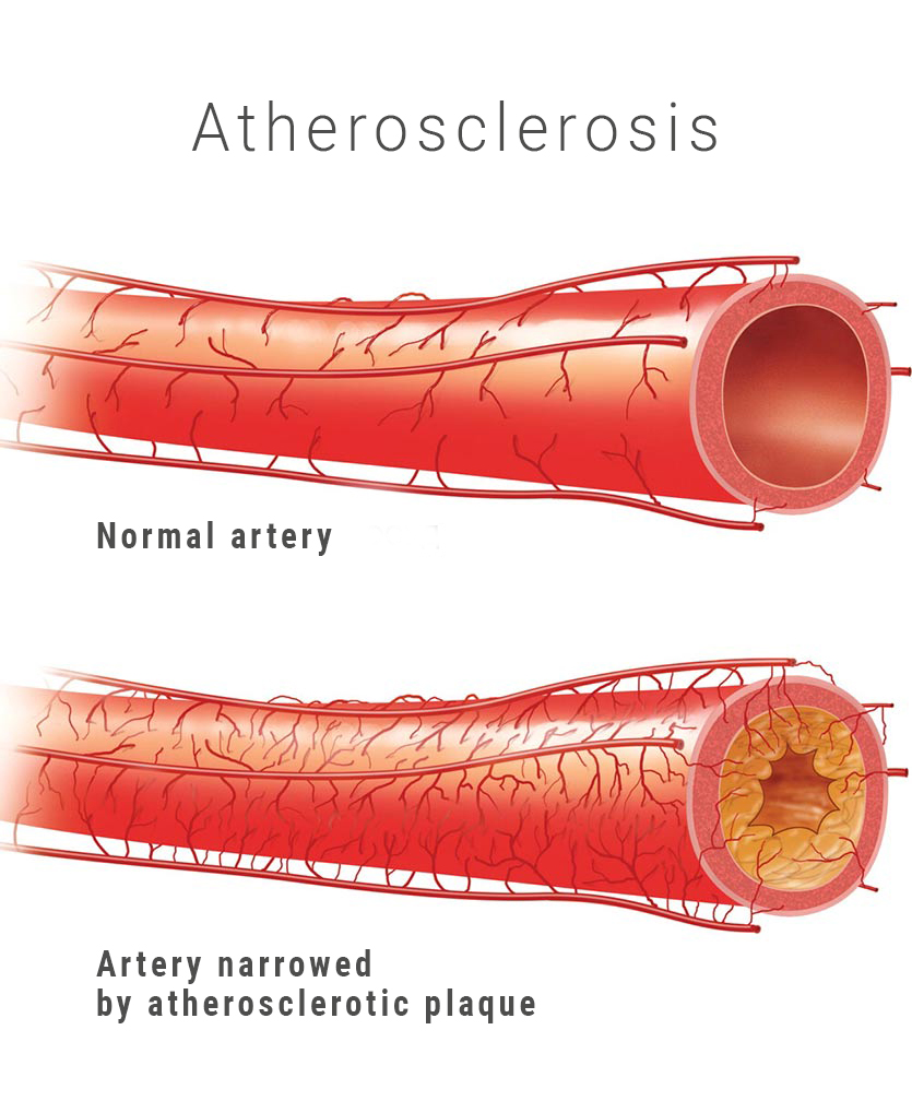 Артерий атеросклероз латынь. Атеросклеротическое поражение артерий. Атеросклеротического поражения стенок кровеносных сосудов. Атеросклероз коронарных артерий симптомы. Атеросклероз сосудов бца.