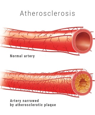 Файл:Atherosclerosis.jpg