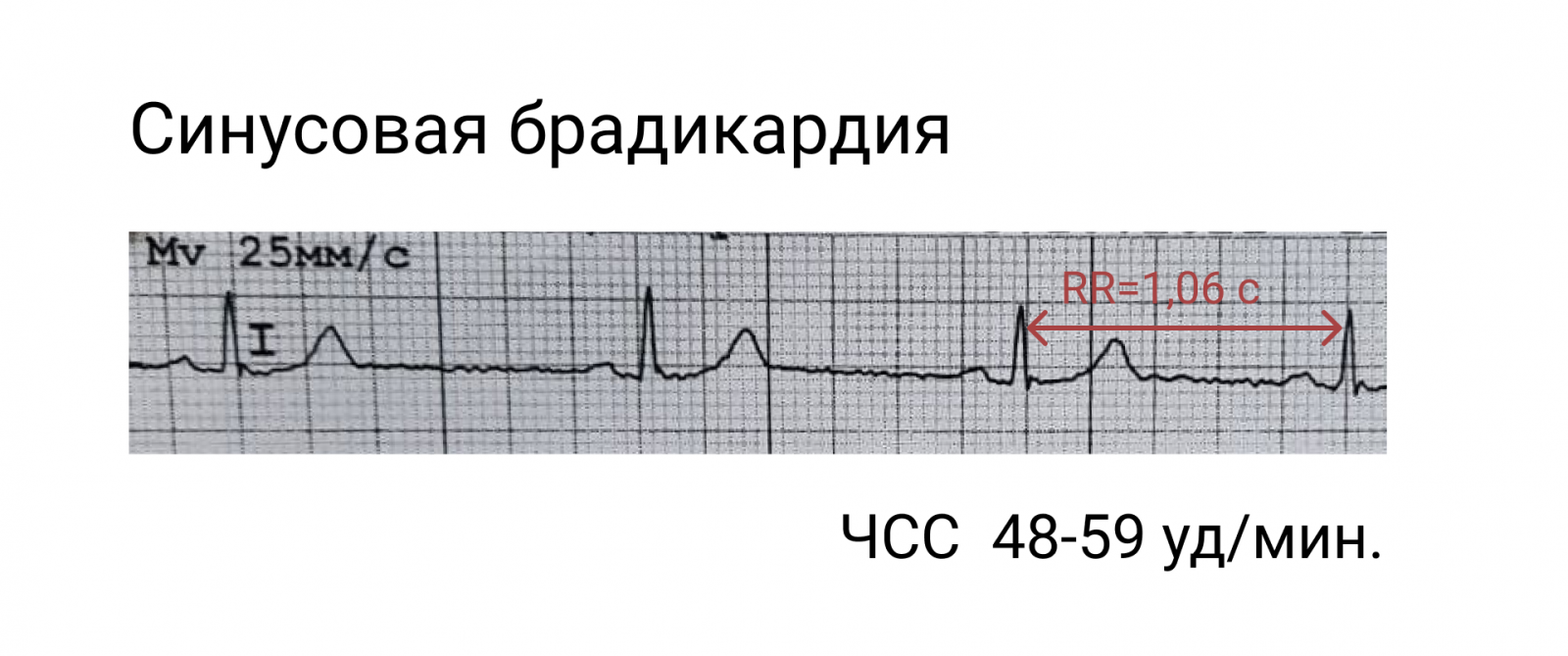 Синусовая брадикардия на ЭКГ. ЭКГ брадикардия синусовый ритм. Синусовая тахикардия на ЭКГ. Брадикардия сердца на ЭКГ.